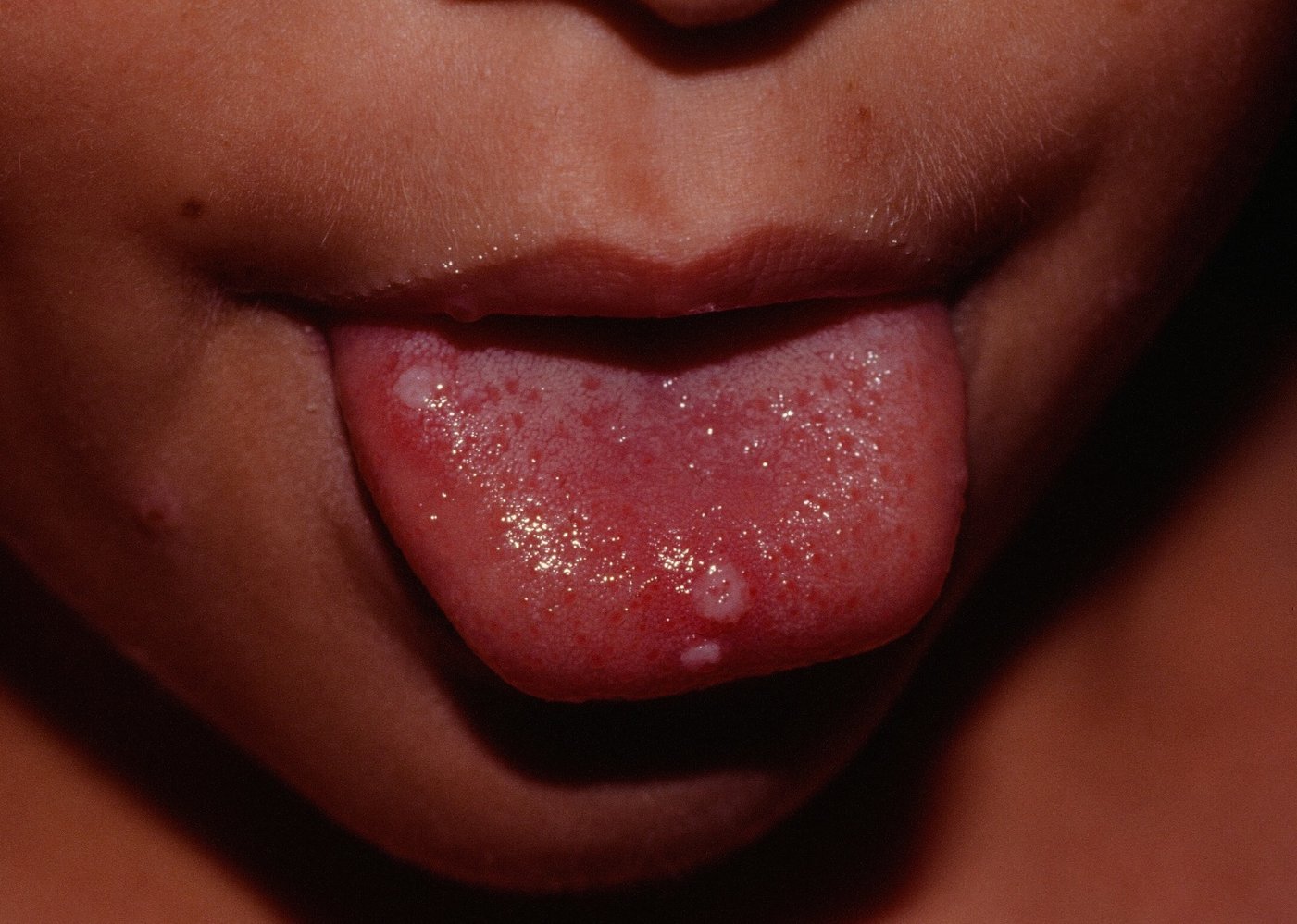 Aphthae