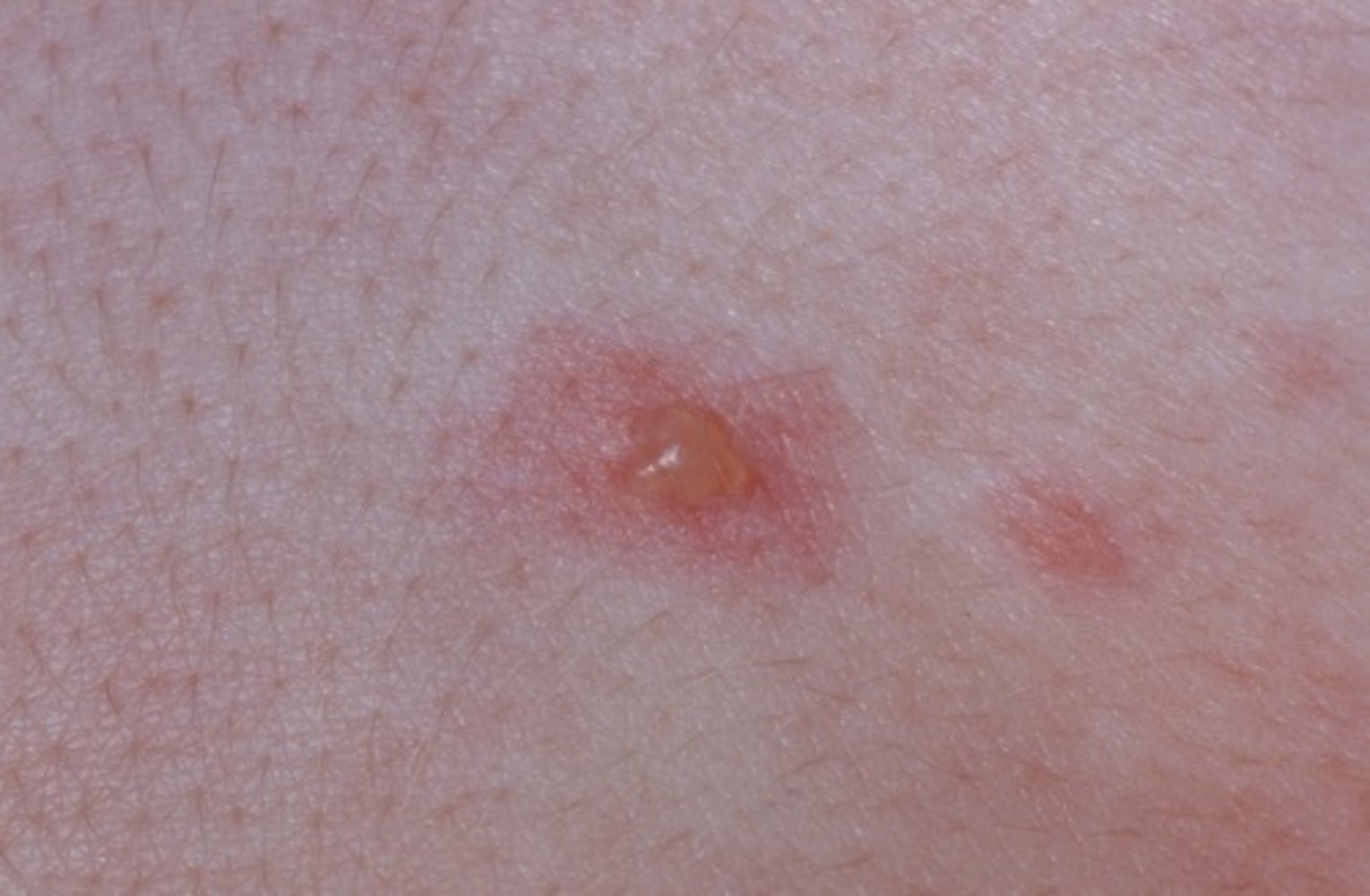 Chickenpox