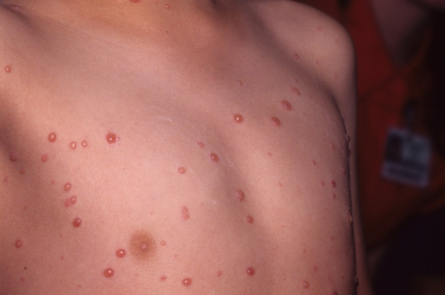Chickenpox