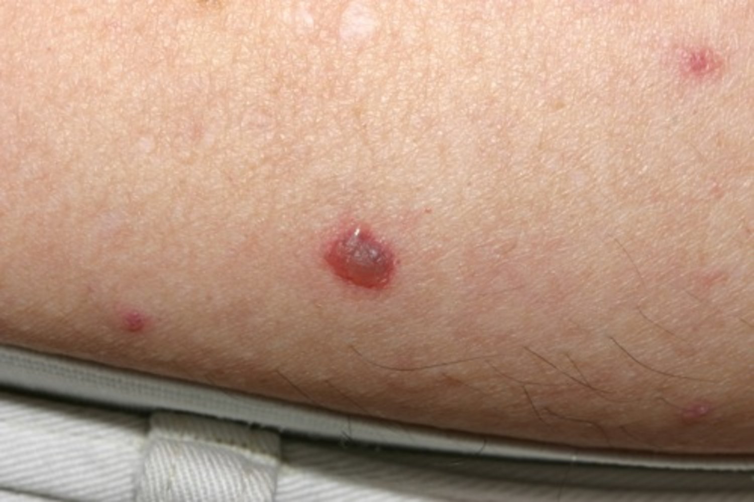 Chickenpox