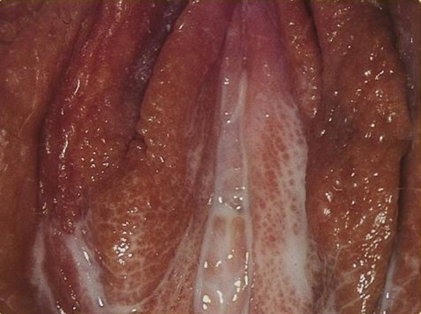 Vaginal discharge in gonococcal infection