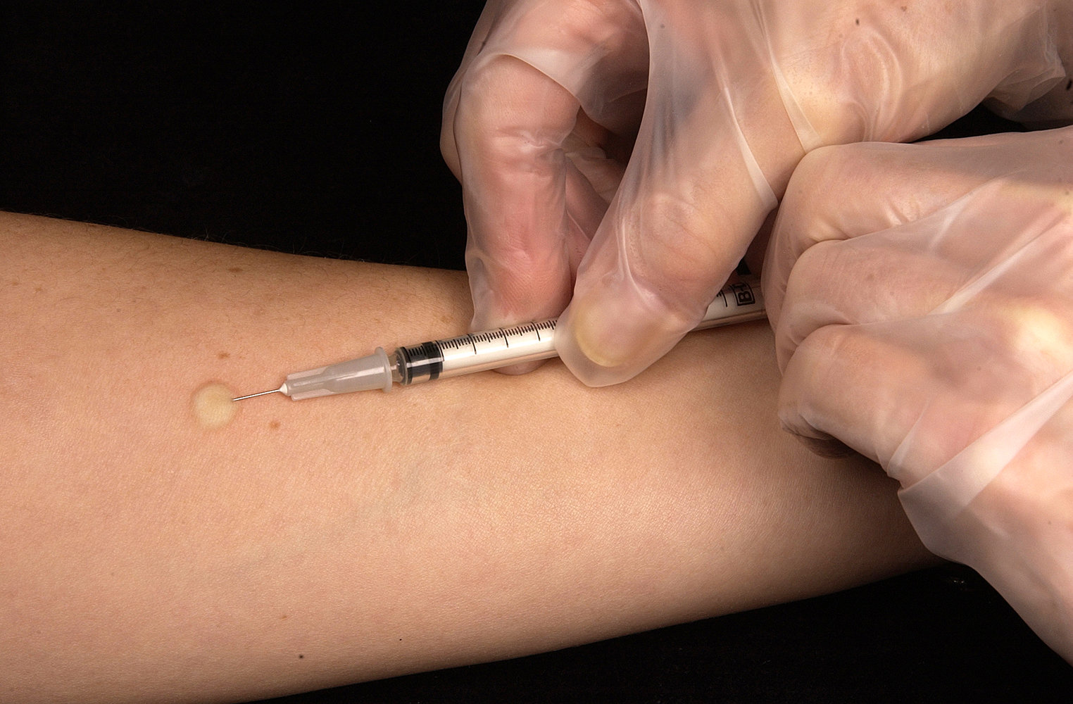 Tuberculin skin test (Mendel-Mantoux test)