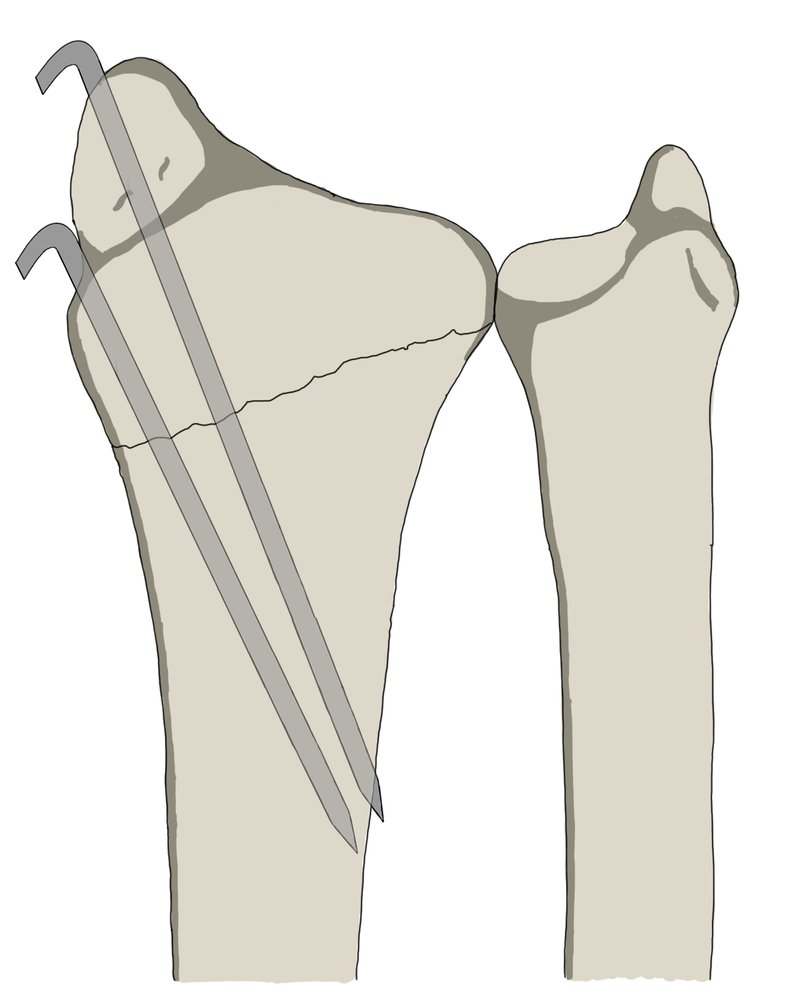 Kirschner wire (K-wire) fixation of distal radius fracture