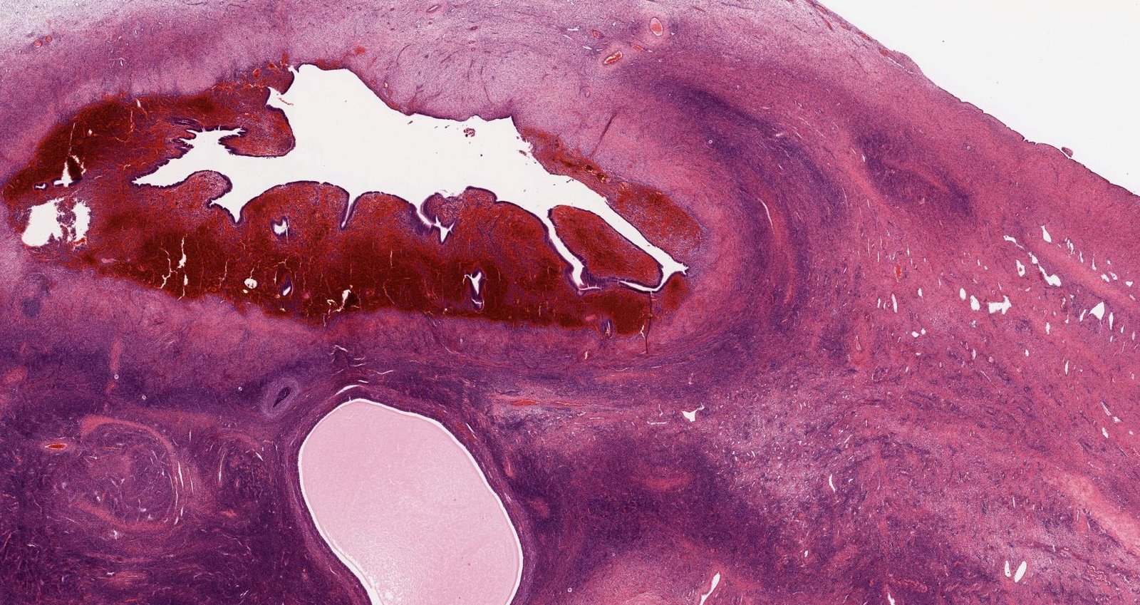 Ovarian endometriosis