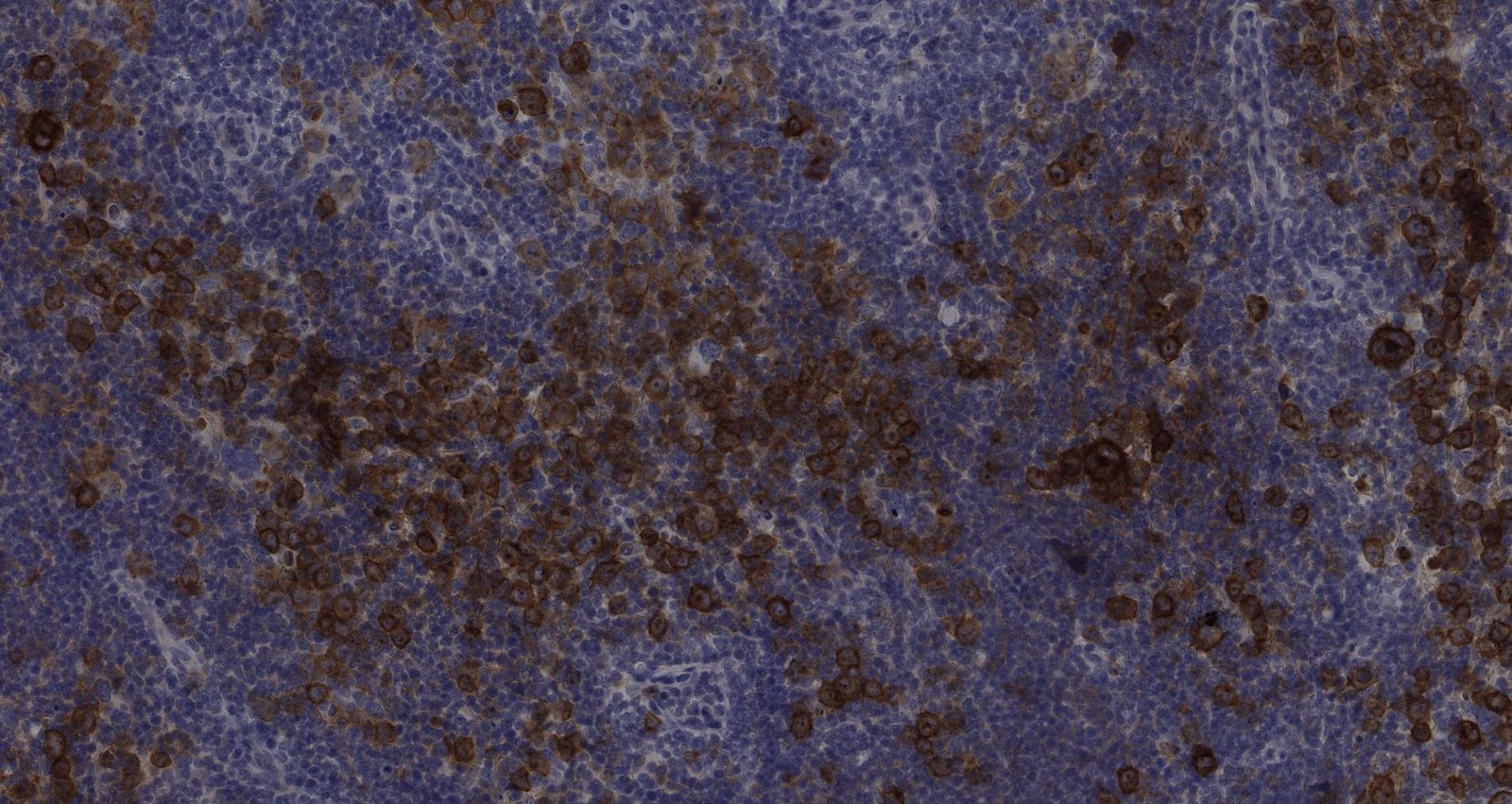 Hodgkin lymphoma (immunhistochemistry for CD30)