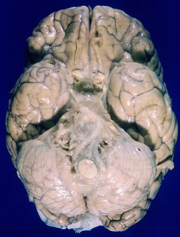 Tuberculous meningitis