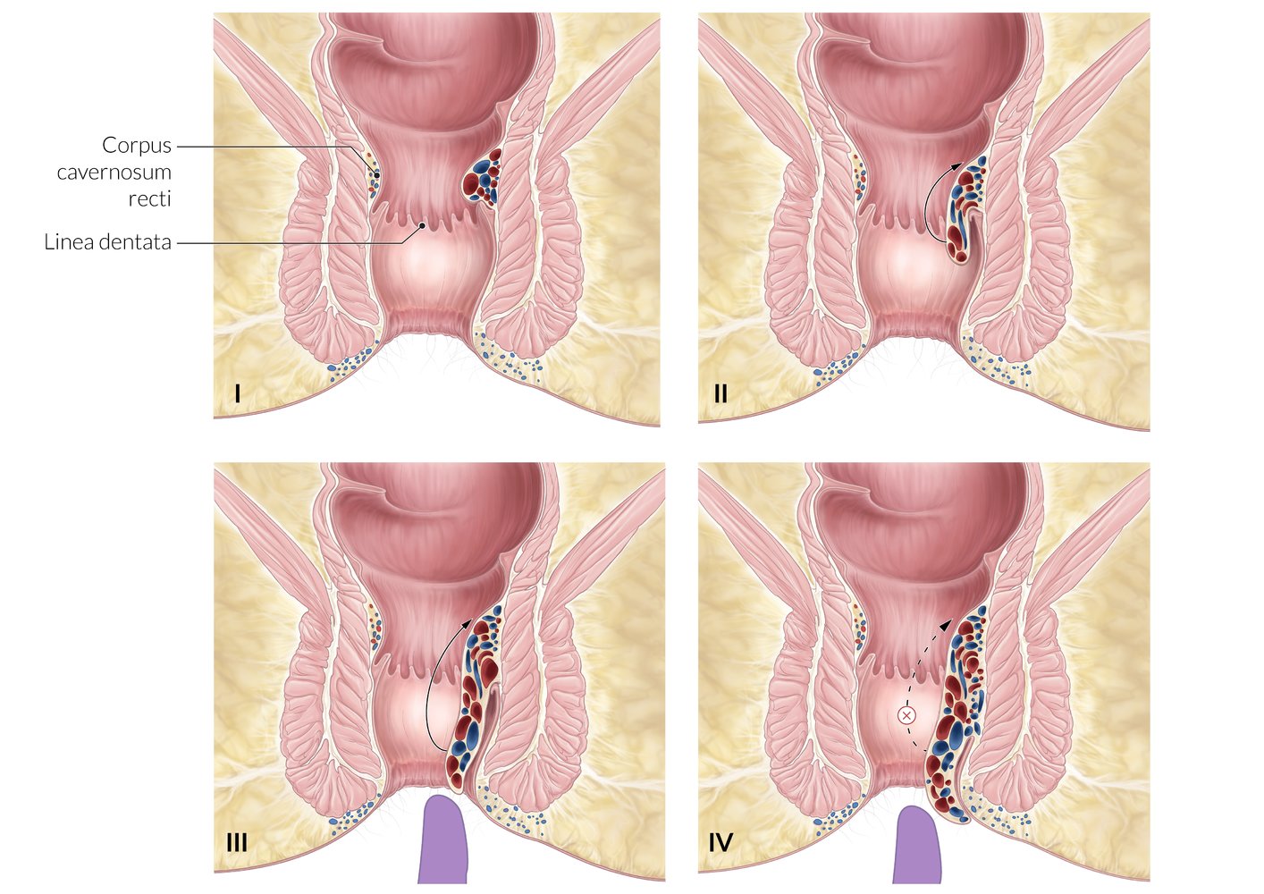 Classification of internal hemorrhoids