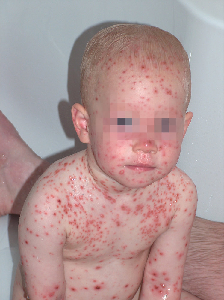 Chickenpox