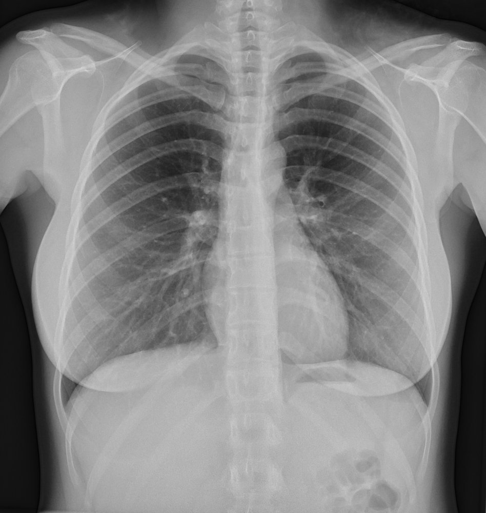 Shoulder X-ray