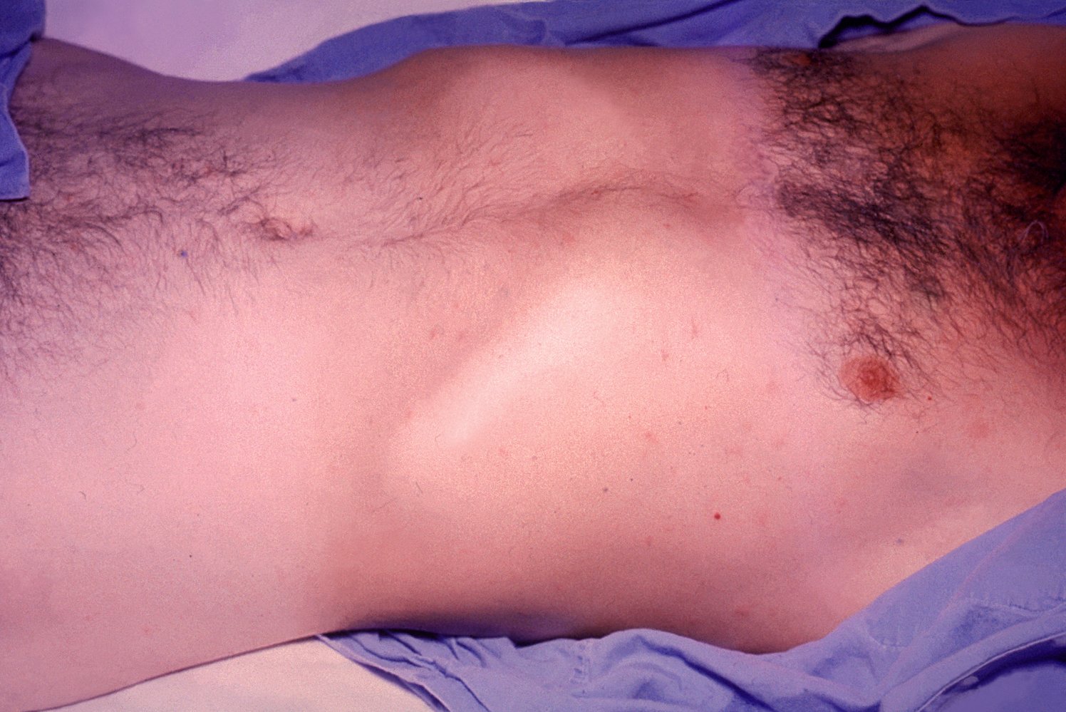 Rose-colored spots on typhoid patient