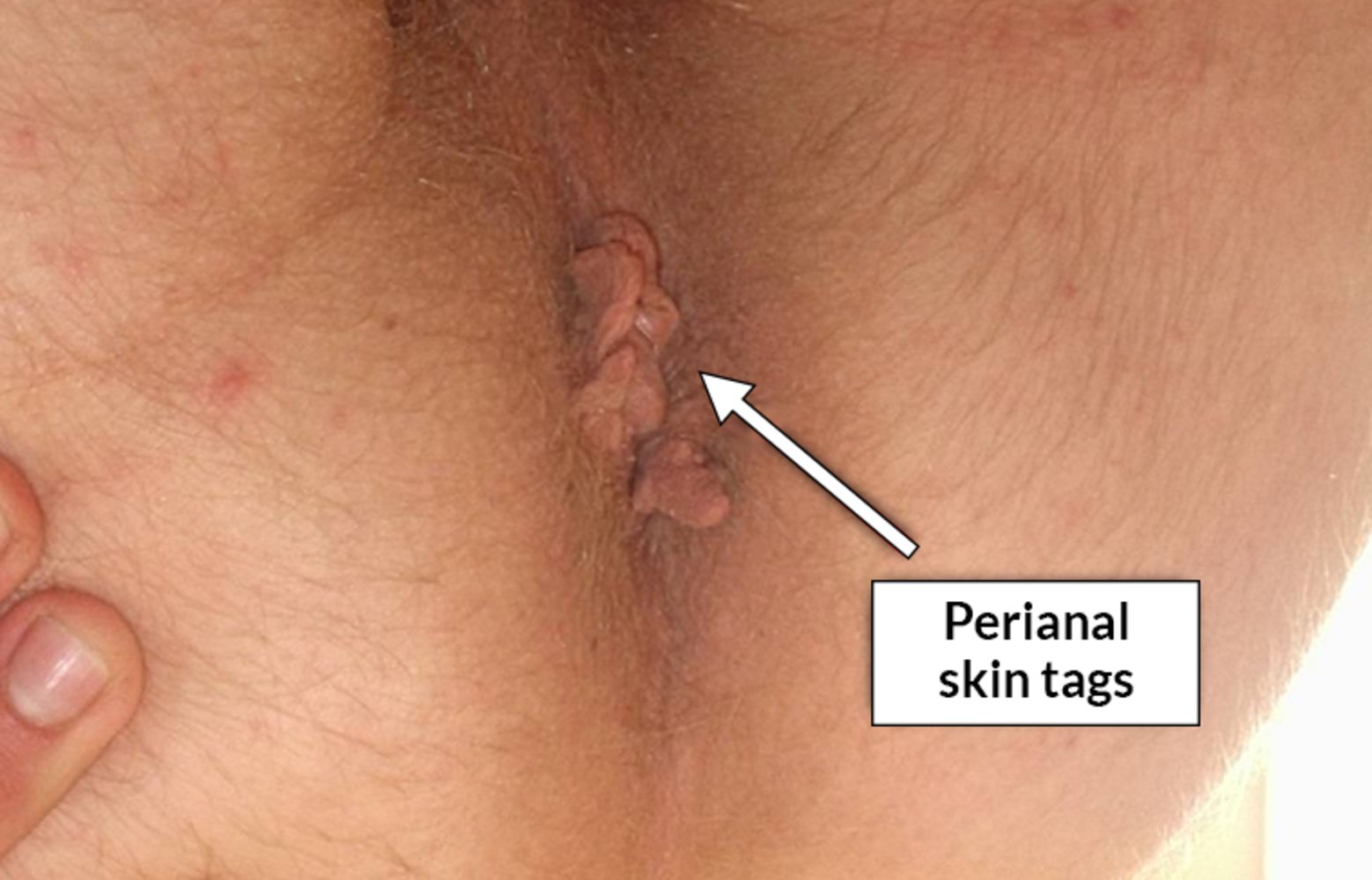 Perianal skin tags