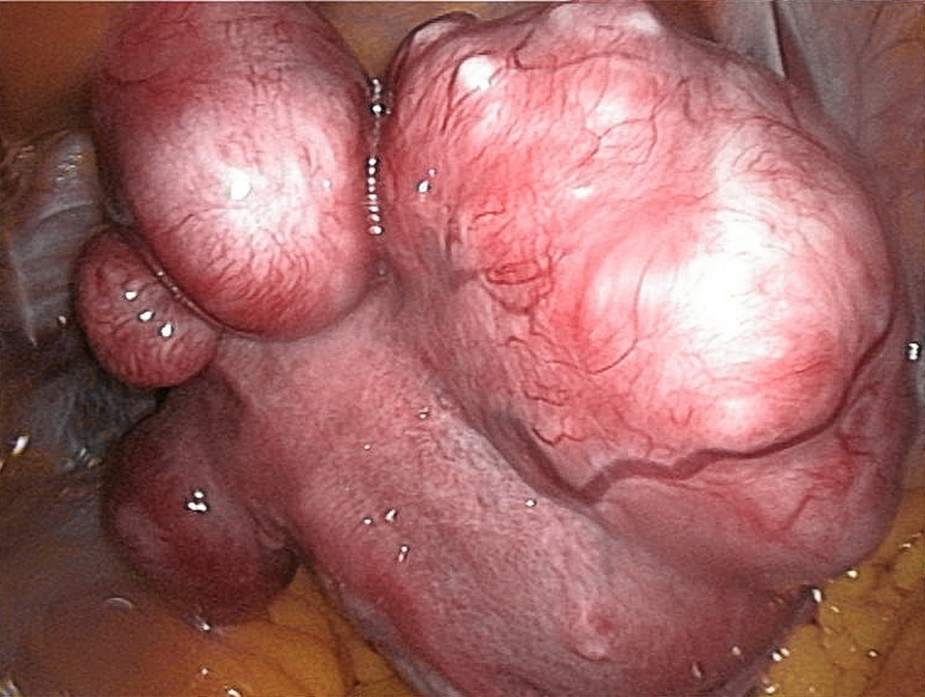 Uterine leiomyomas