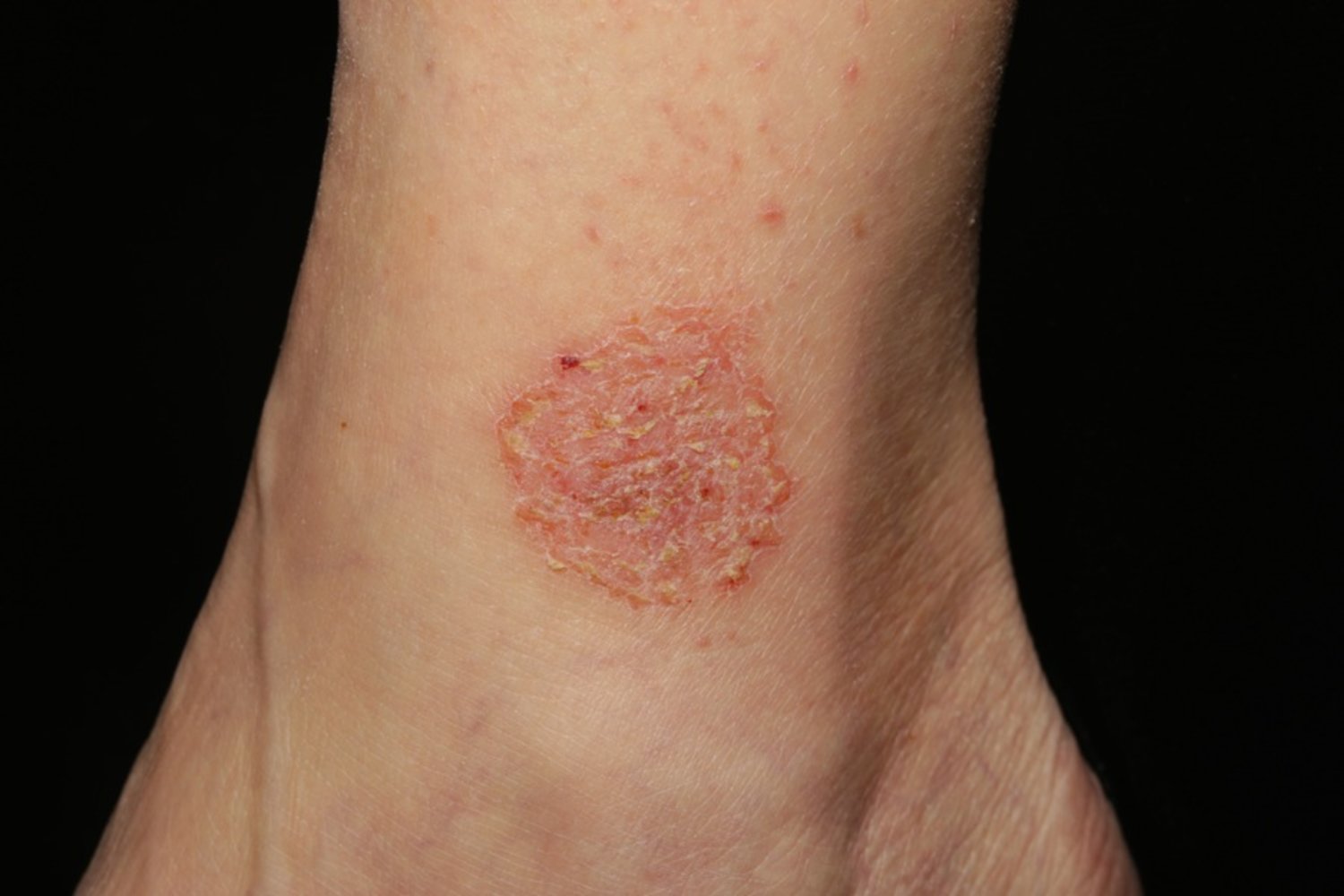 Nummular eczema