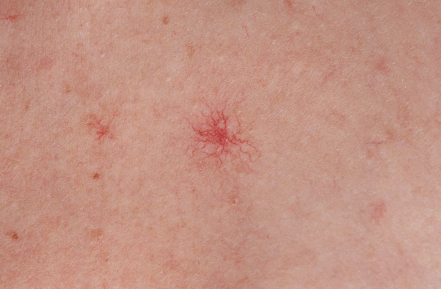 Spider angioma