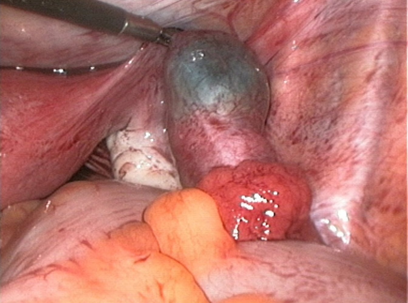 Tubal pregnancy