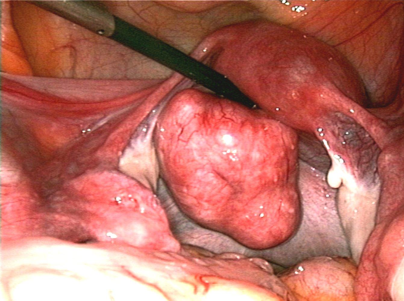 Pedunculated uterine fibroid