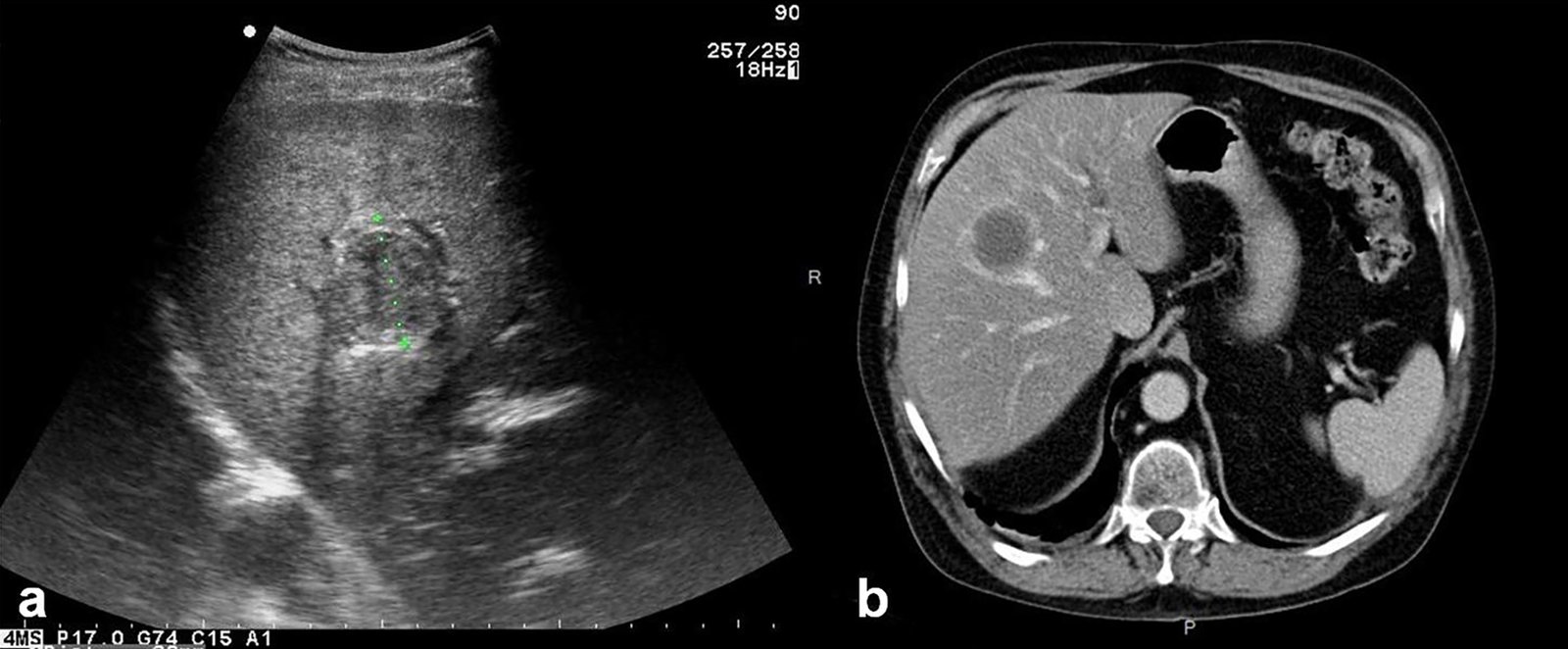 Hepatic echinococcosis with lung involvement
