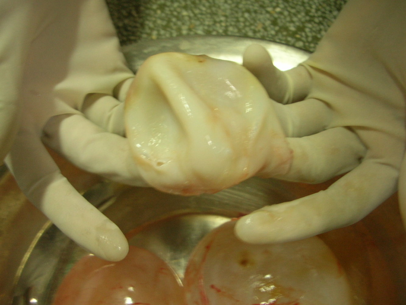 Cystic echinococcosis
