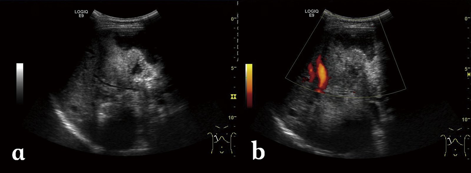 Hepatic echinococcosis