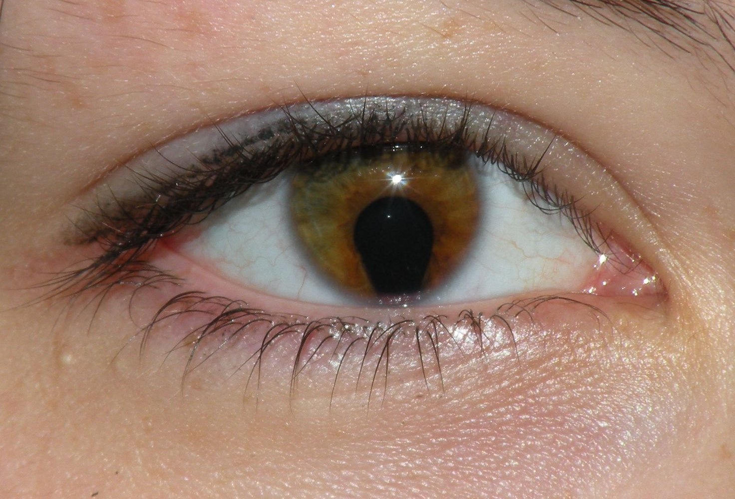 Coloboma of the iris