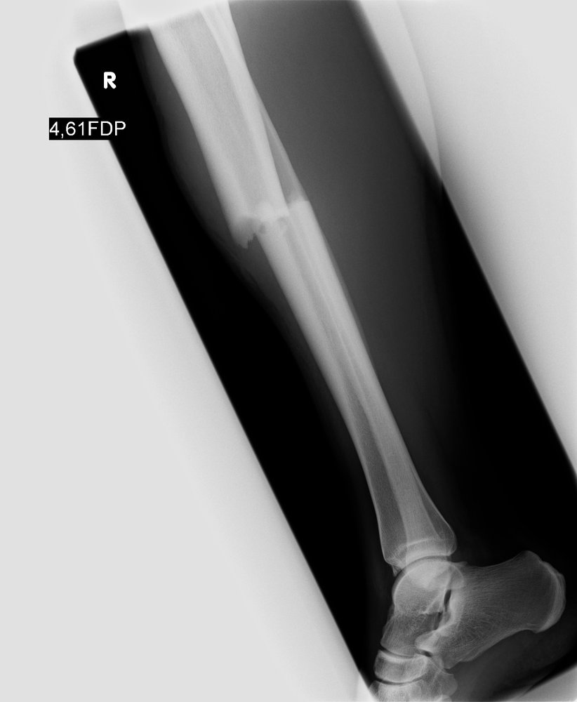 Tibial fracture