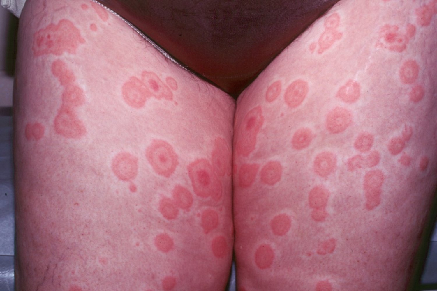 Erythema multiforme