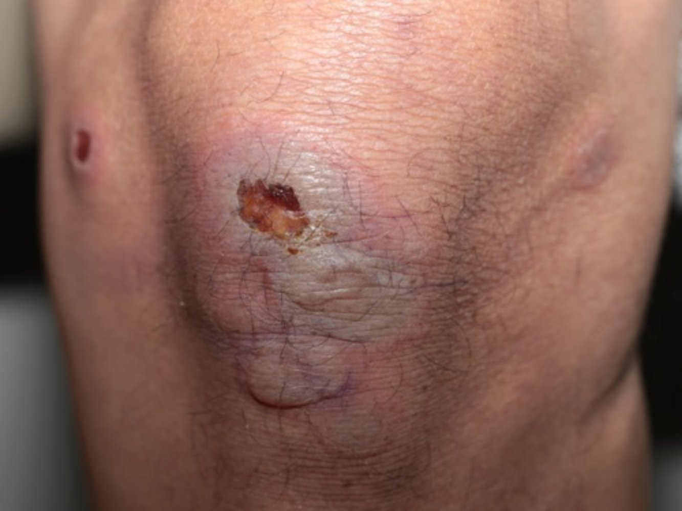 Blisters in erythema multiforme