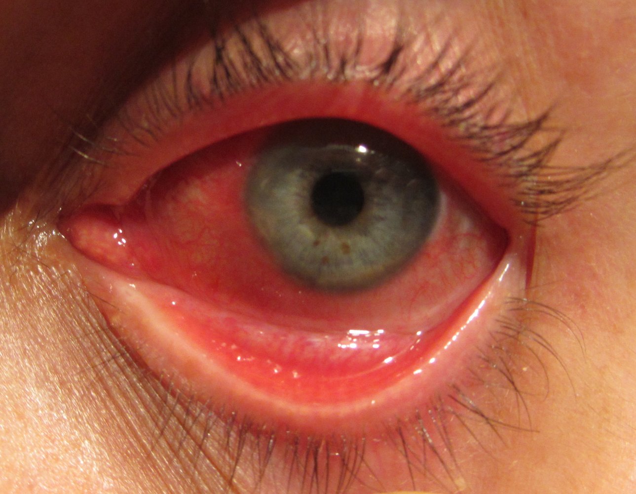 Conjunctivitis
