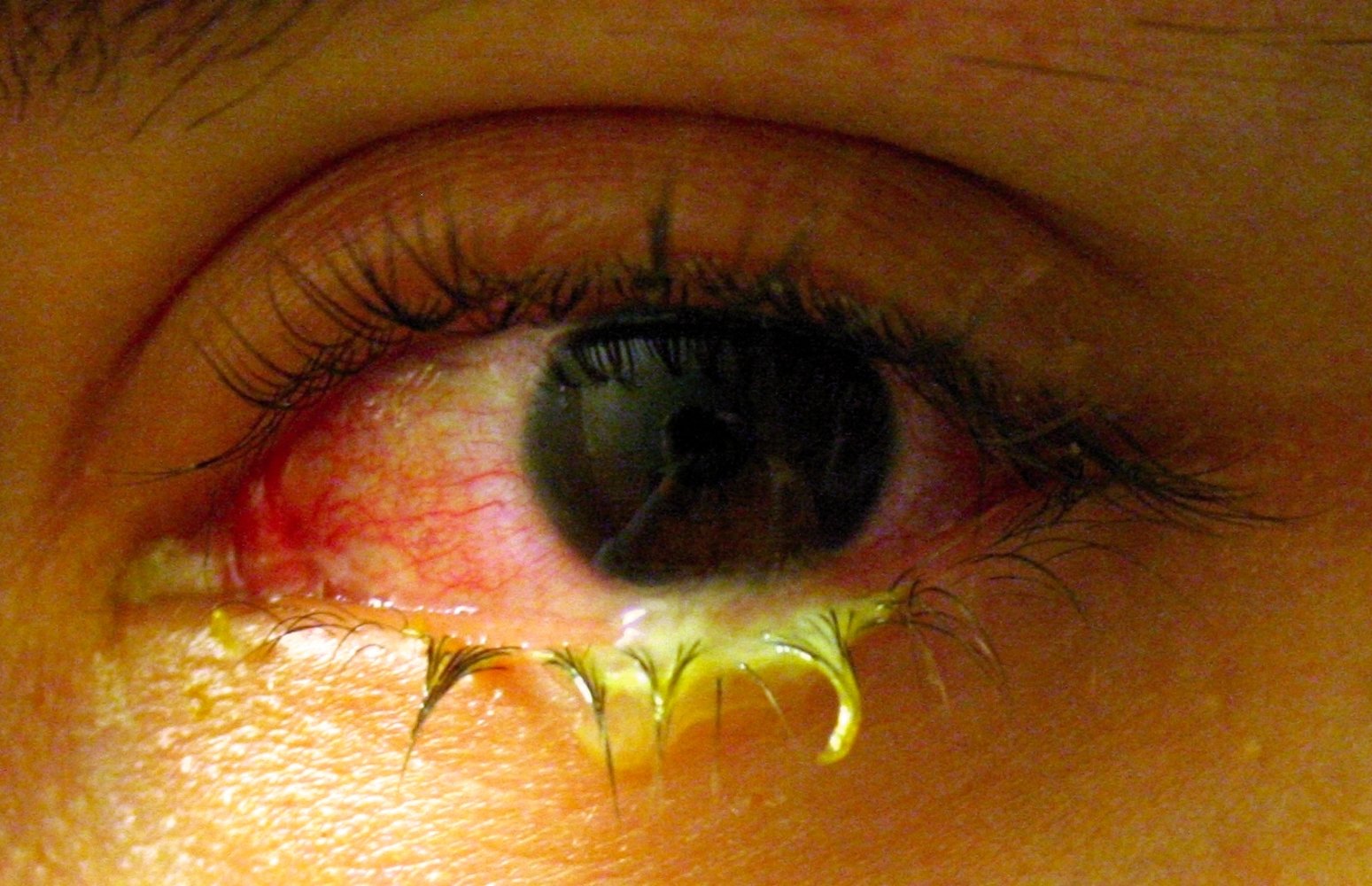 Bacterial conjunctivitis