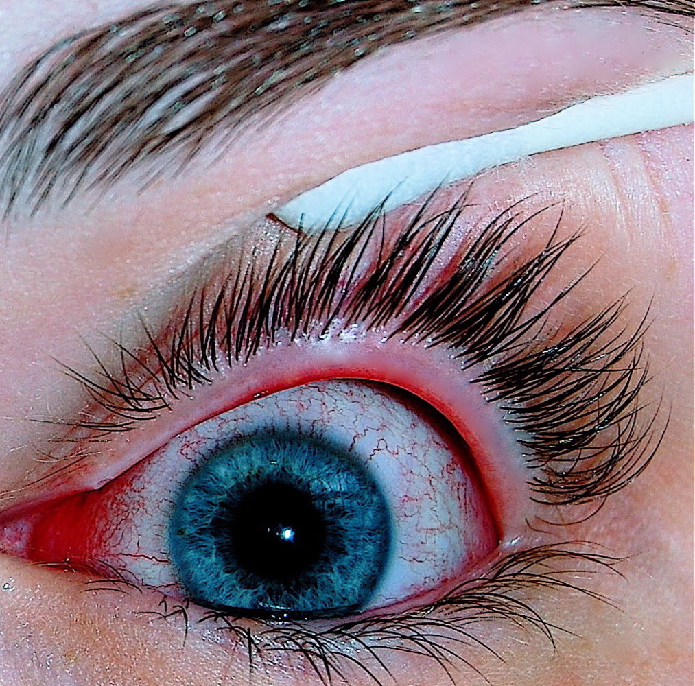 Viral conjunctivitis