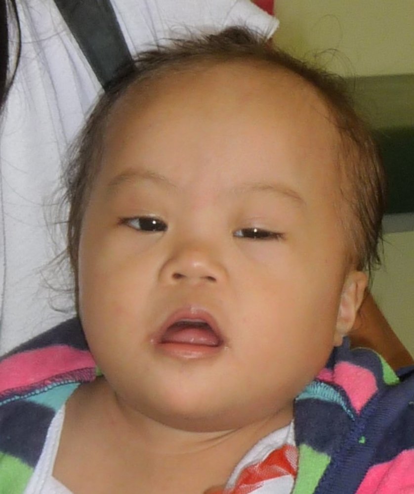 Facial features of Down syndrome