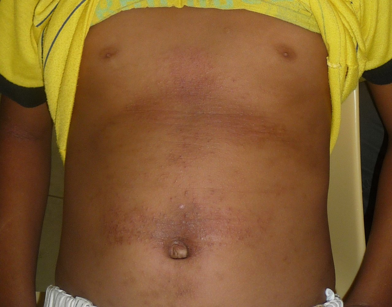 Scabies