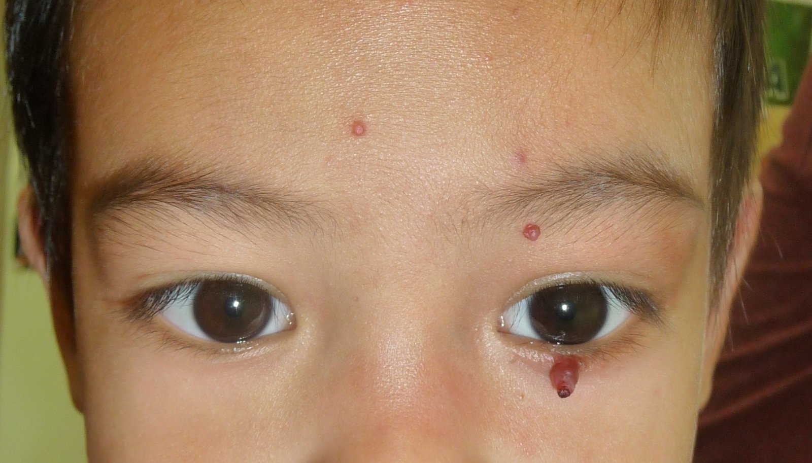 Infantile hemangioma