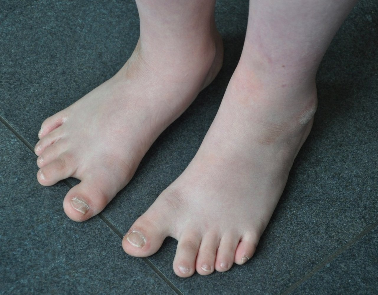 Sandal gap