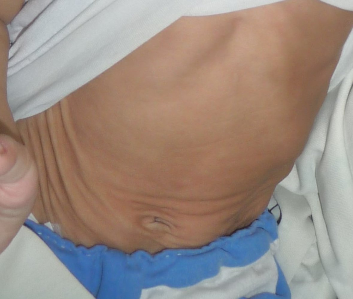 Severe dehydration in an infant