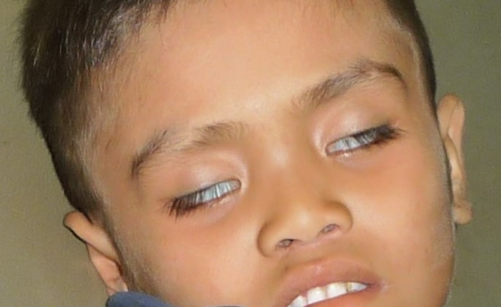 Sunken eyes in dehydration