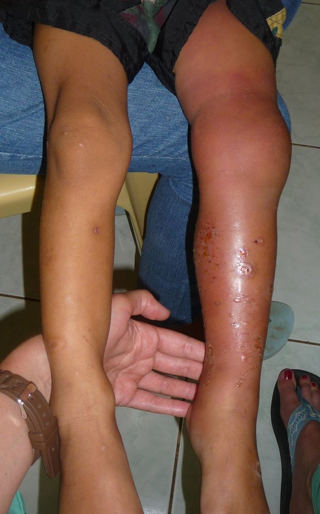 Cellulitis in superinfected scabies