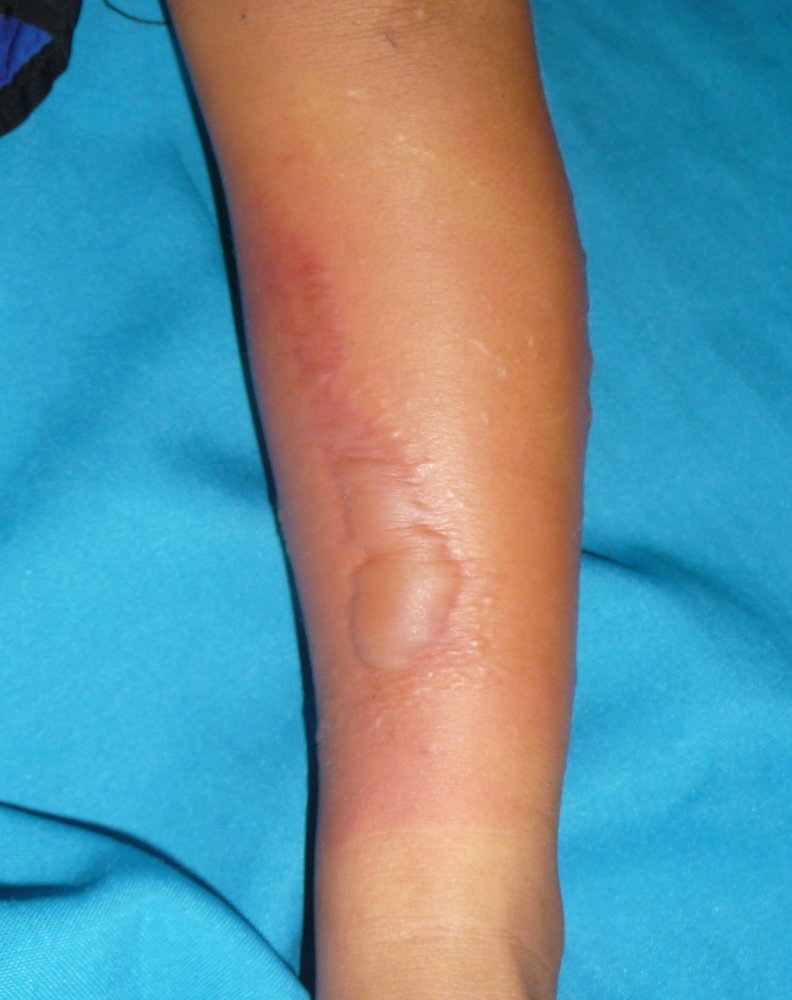 Erysipelas with blisters