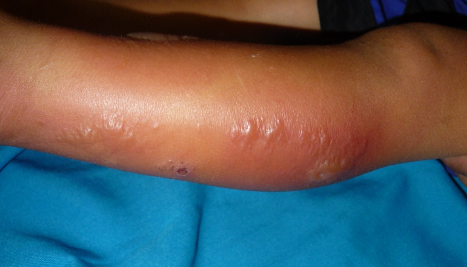 Erysipelas with blisters