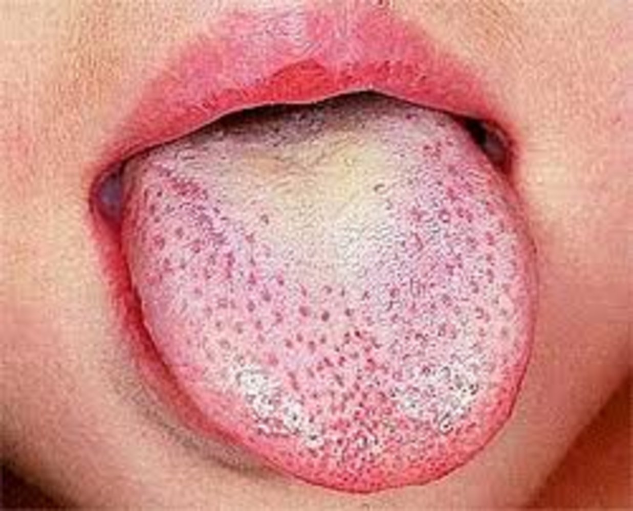 White strawberry tongue