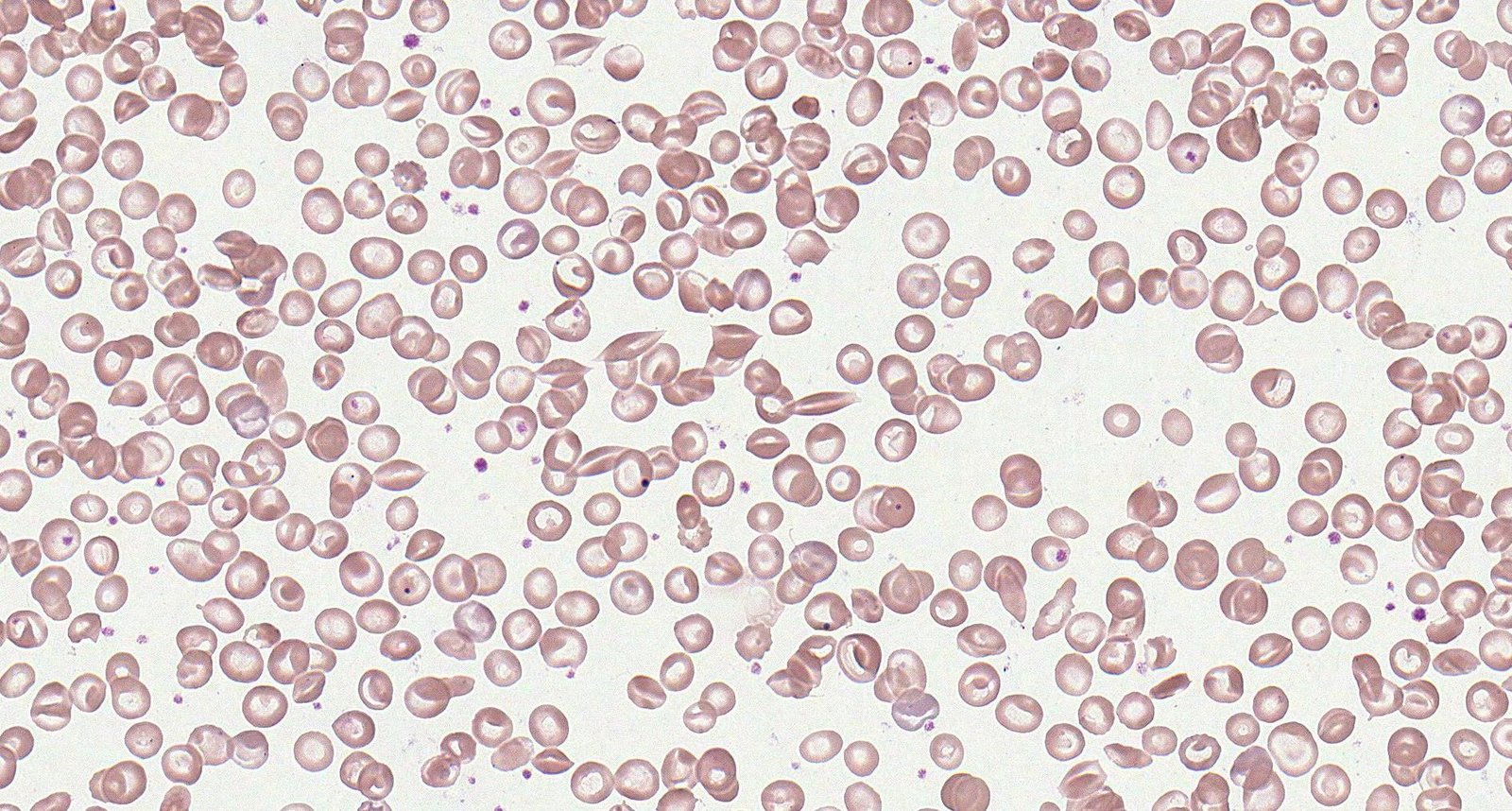 Sickle cell disease