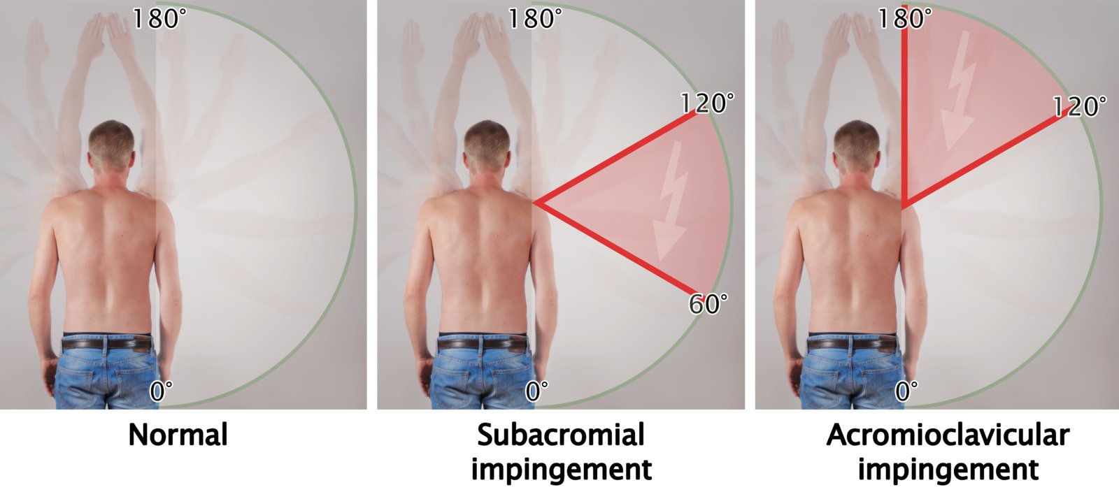Normal range of shoulder abduction and pain in impingement