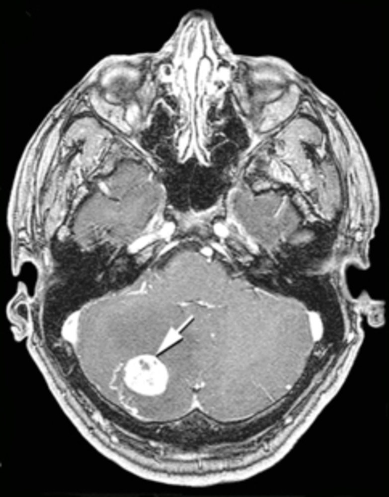 Cerebellar hemangioblastoma
