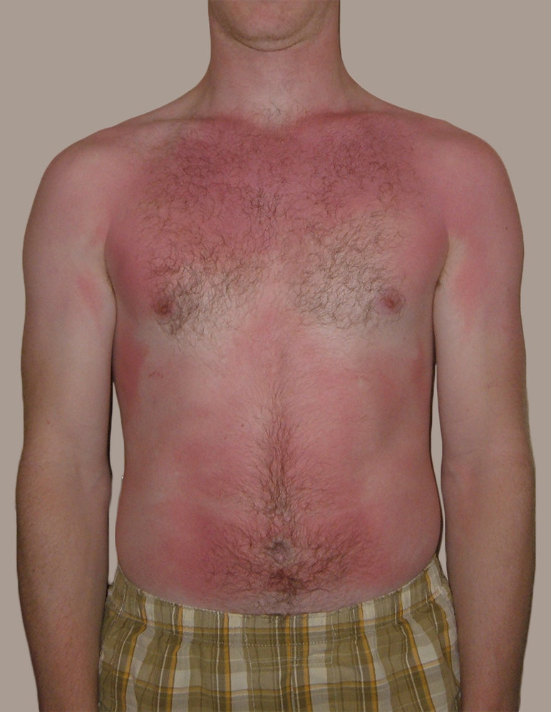 First-degree burn (superficial burn)