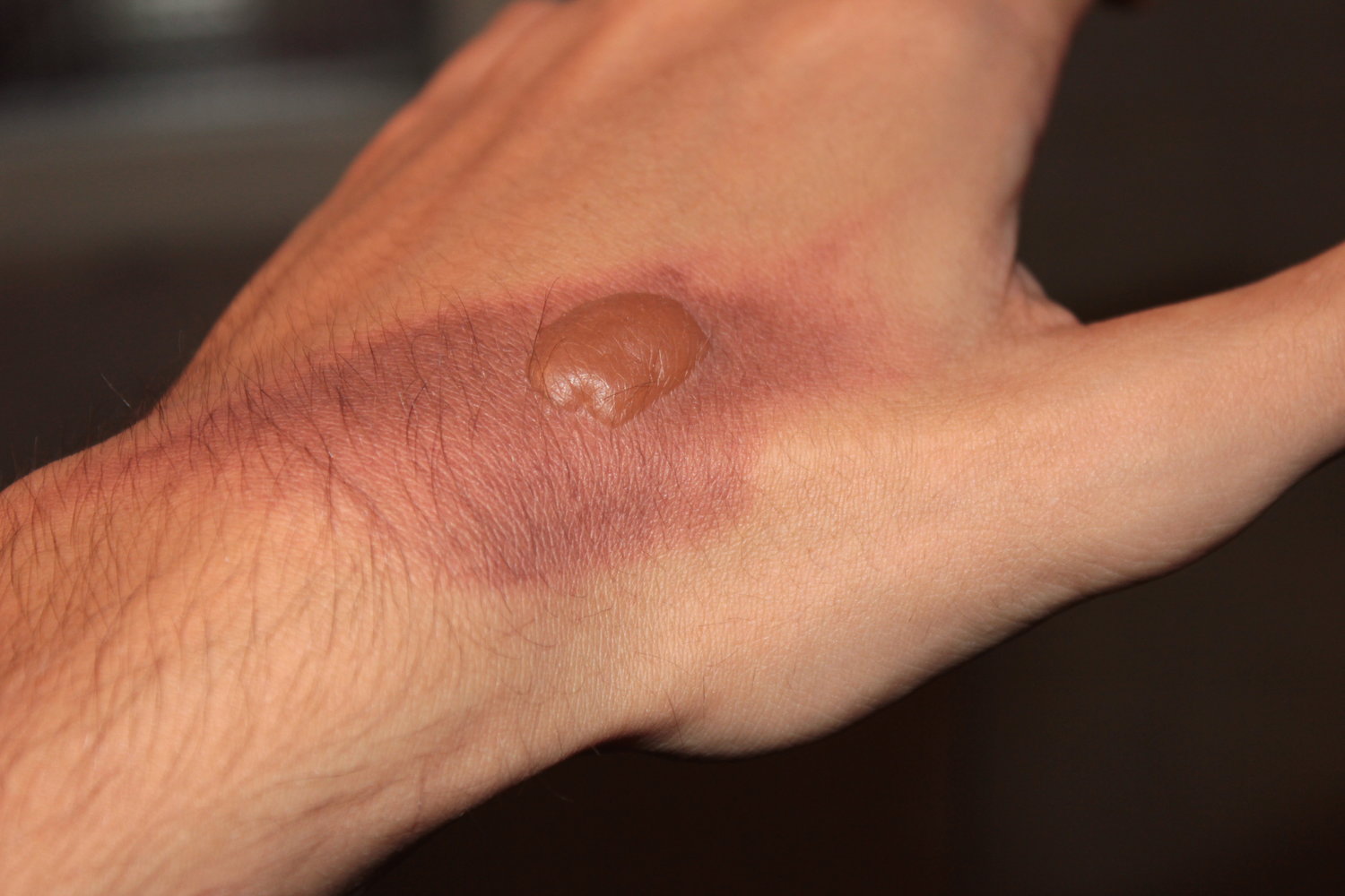 Second-degree burn (2a; superficial partial-thickness burn)