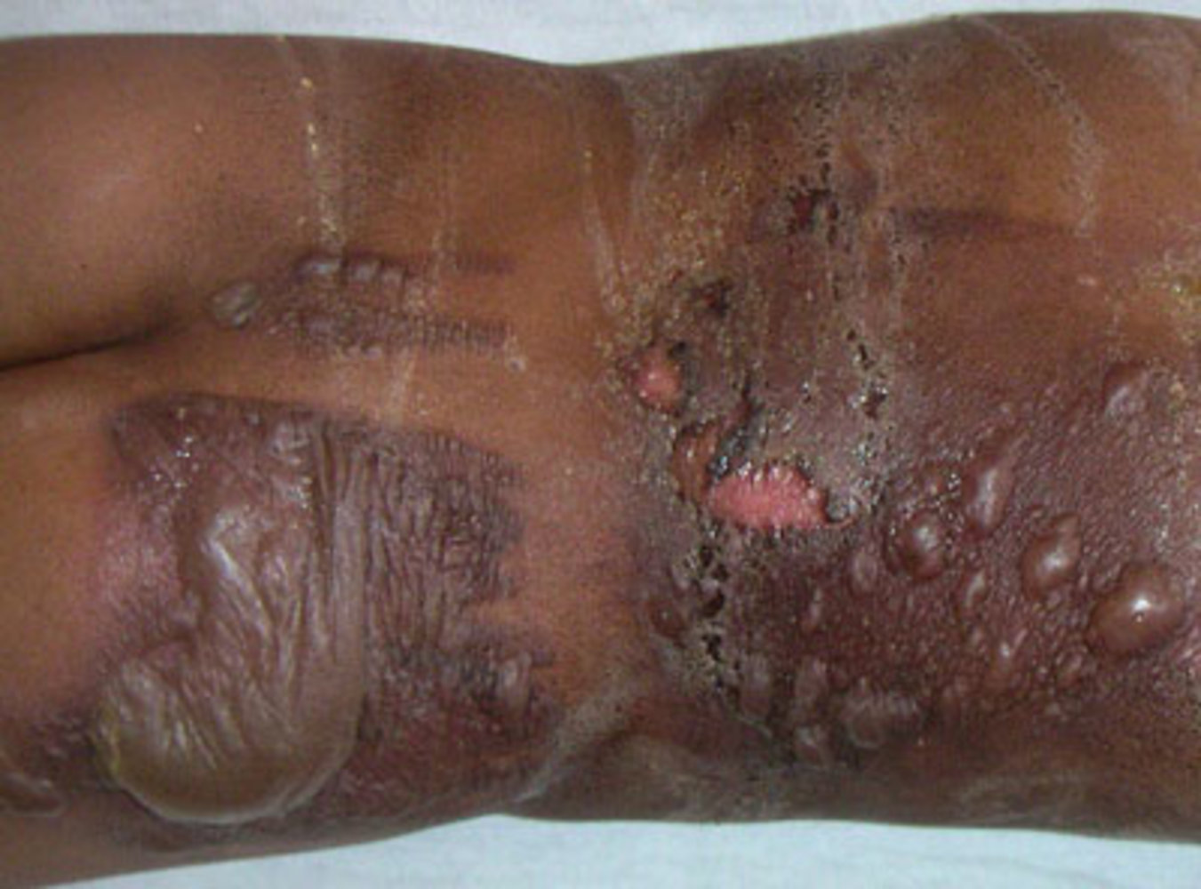 Second-degree burn (2b; deep partial-thickness burn)