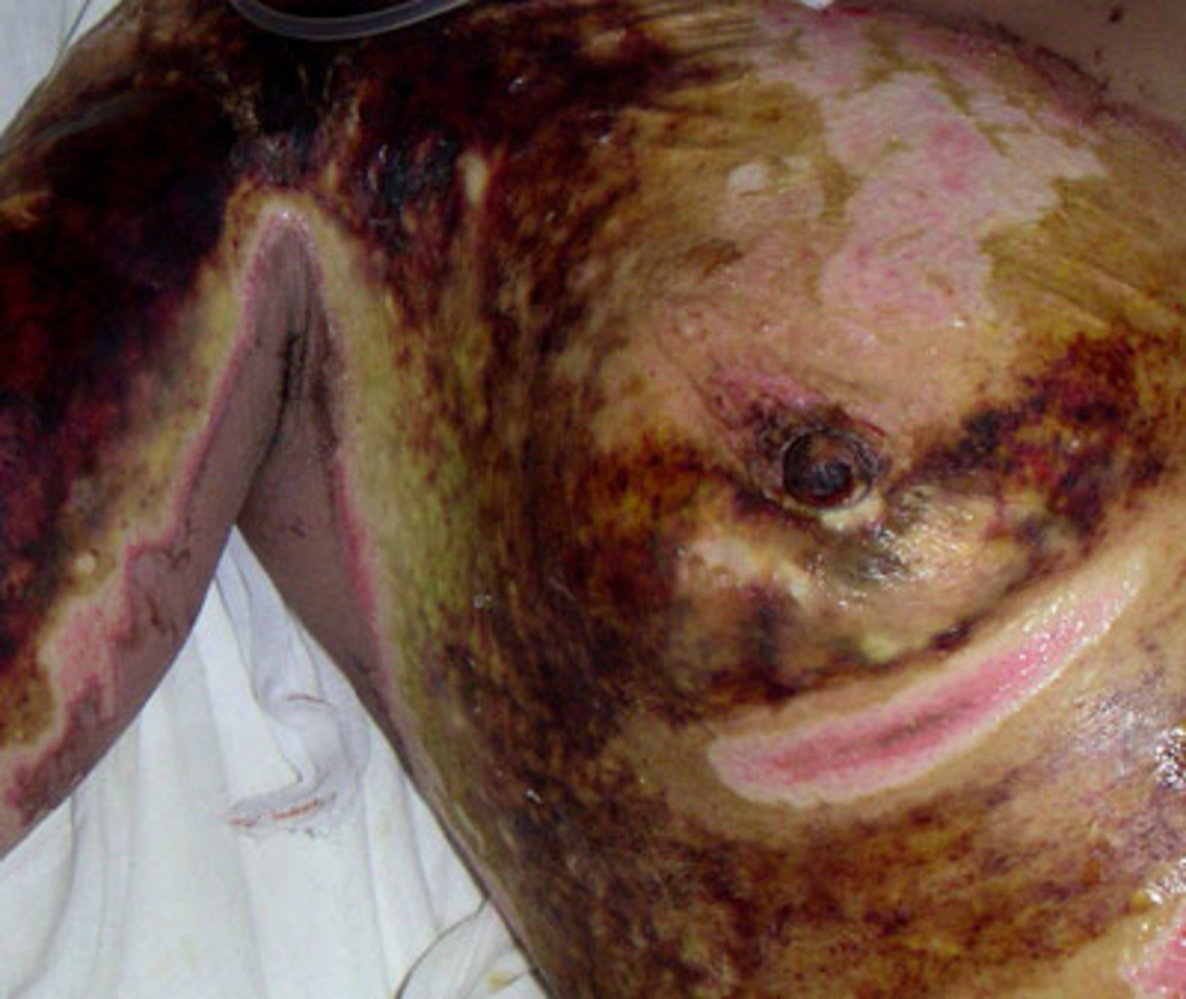 Third-degree burn (full-thickness burn)