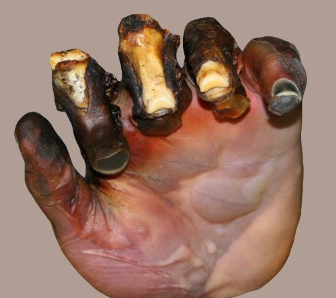 Fourth-degree burn (deeper injury burn)