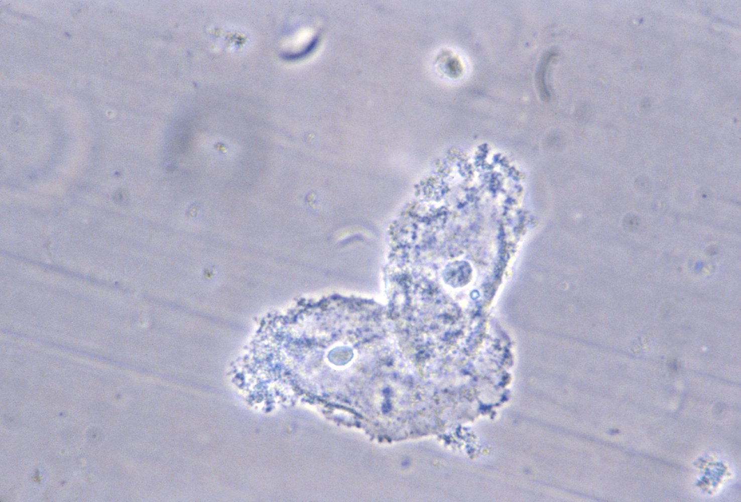 Clue cells in bacterial vaginosis