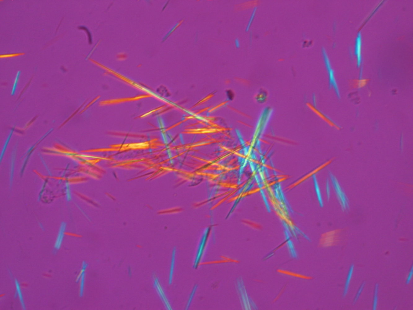Synovial fluid crystals in gout